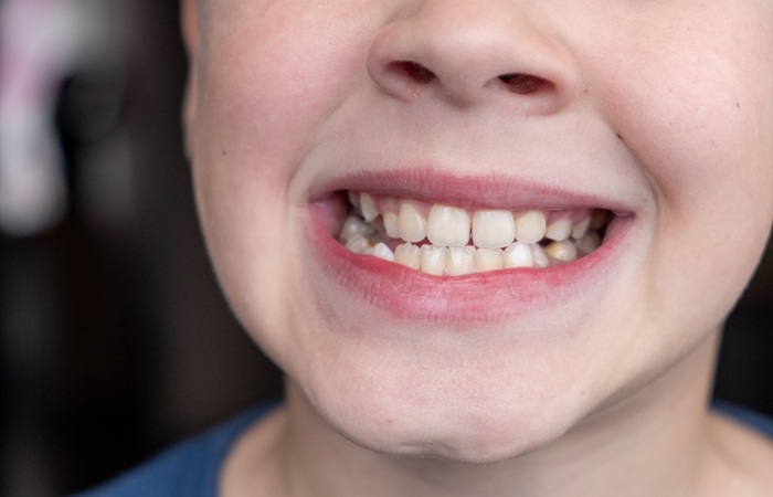Comum entre crianças e adolescentes, desalinhamento dental causa dificuldades na mastigação e fala, distúrbios no sono e pode ocasionar perda de dentes Créditos: Envato